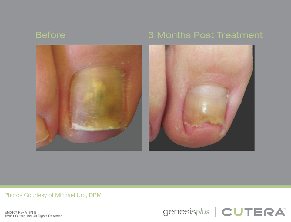 nail fungus laser treatment pickering before and after